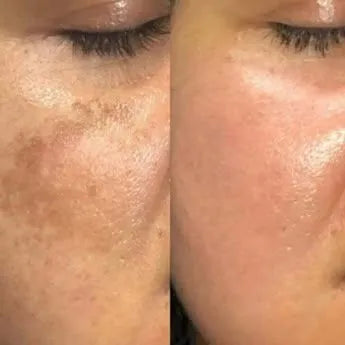 Kit Serum Manchas